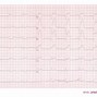 Image result for Anterior Myocardial Infarction ECG