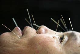 Image result for Chinese Medicine and Acupuncture