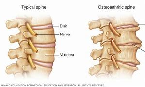 Image result for Bone Spurs Spine