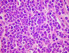 Image result for Small Cell Carcinoma Diagram