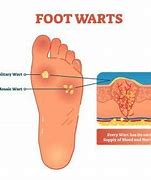 Image result for Warts On Top of Feet