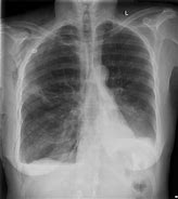 Image result for Collapsed Lung On X-ray