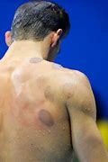Image result for Michael Phelps Cupping Therapy