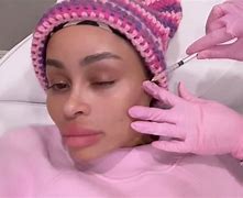 Image result for Blac Chyna dissolves facial fillers