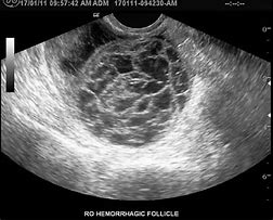 Image result for Follicular Cyst Ultrasound