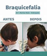 Image result for braquicefalia