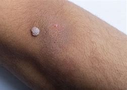 Image result for Wart On Forearm