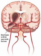 Image result for Intracranial Brain Hemorrhage