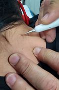 Image result for New Skin Tag Removal