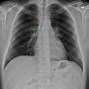 Image result for X-ray of Heart
