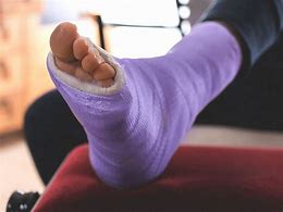 Image result for Smashed Foot Injury