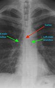 Image result for Chest Tube X-ray