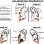 Image result for small cells lung cancers stage