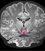 Image result for CT Scan of OCD Brain