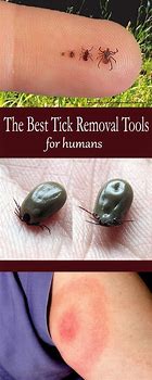 Image result for What Does a Embedded Tick Look Like