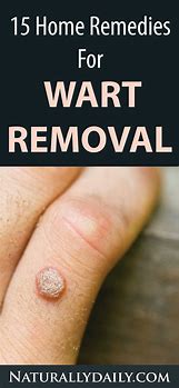 Image result for warts remove home remedy