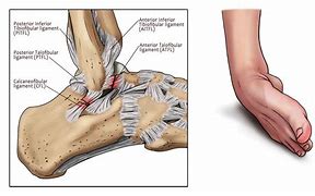 Image result for Foot Injury