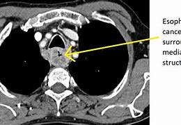 Image result for Esophagus CT