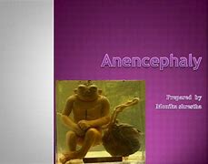 Image result for All Images of Anencephaly