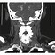 Image result for V3 Segment Vertebral Artery