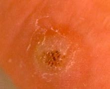 Image result for Types of Warts On Ankles