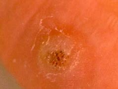 Image result for Pictures of Plantar Warts