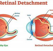 Image result for Retinal Detachment Cat
