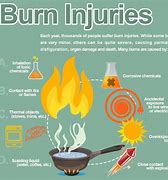 Image result for Burn Injury