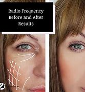 Image result for Radio Frequency Face