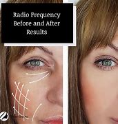 Image result for Radio Frequency Skin