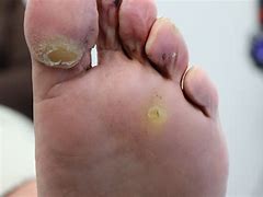 Image result for Corn or Plantar Wart Seed
