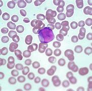 Image result for AML Leukemia