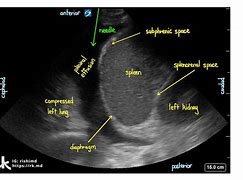 Image result for Anechoic Lung Ultrasound