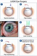 Image result for Lasik Surgery for Myopia