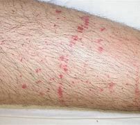 Image result for Petechiae and Purpura