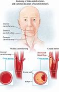 Image result for Distended Carotid Artery