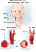 Image result for Carotid Artery in Neck Location