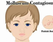 Image result for Molluscum Contagiosum Face Treatment