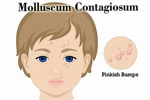 Image result for Molluscum Contagiosum Cartoons