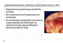 Image result for Adenocarcinoma Cervical Cancer