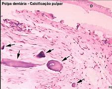 Image result for calcificae