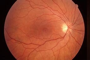 Image result for Anemia Retinopathy