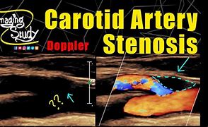 Image result for Carotid Doppler Ultrasound Stenosis