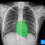 Image result for CXR Normal Chest X-Ray