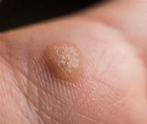 Image result for Types of Hand Warts