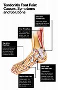 Image result for feet pain cause