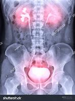 Image result for X-ray Urinary