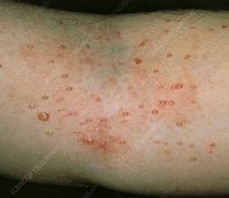 Image result for Skin Virus Molluscum Contagiosum