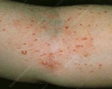 Image result for Molluscum Contagiosum Eczema