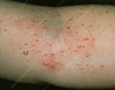 Image result for Molluscum with Cellulitis